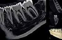 Tomograf 3d CBCT - tryb endodontyczny